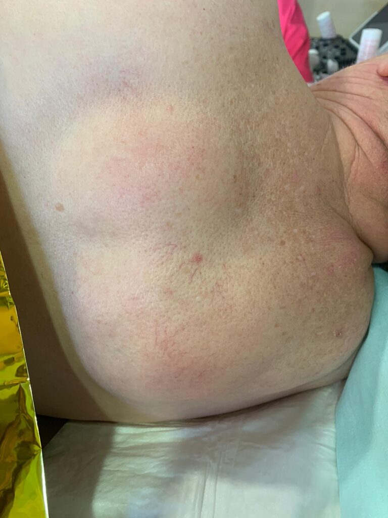 lipoma